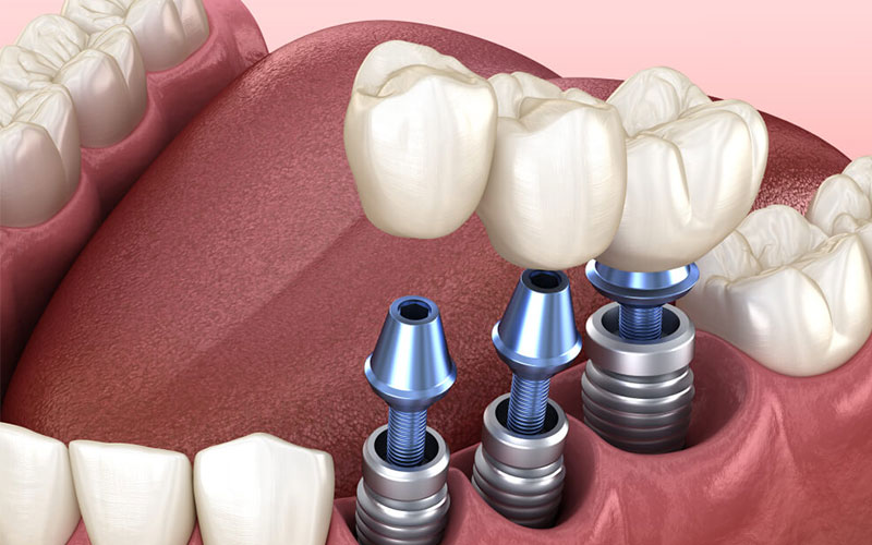  چرا ایمپلنت دندان، بهترین گزینه ممکن برای جایگزینی دندان های از دست رفته است؟